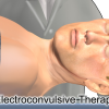 Terapia electroconvulsiva